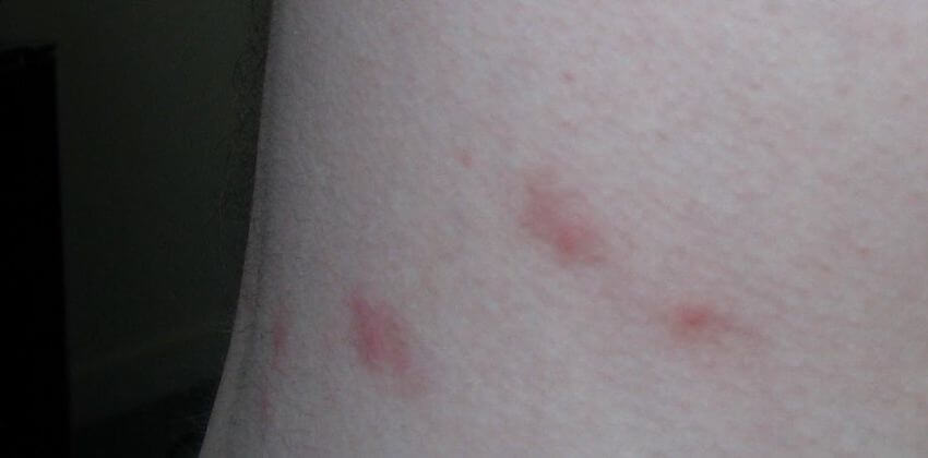 Bed bug bites vs flea bites