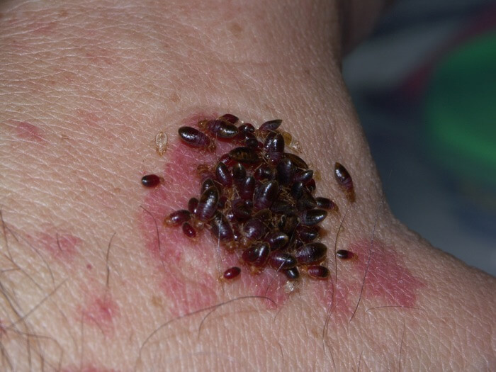 Baby bed bugs biting someone