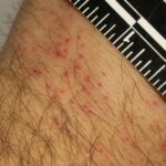 Bed bug bites but no sign of bed bugs