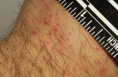 Bed bug bites but no sign of bed bugs