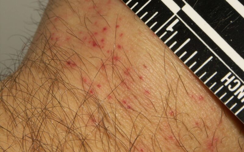 Bed bug bites but no sign of bed bugs
