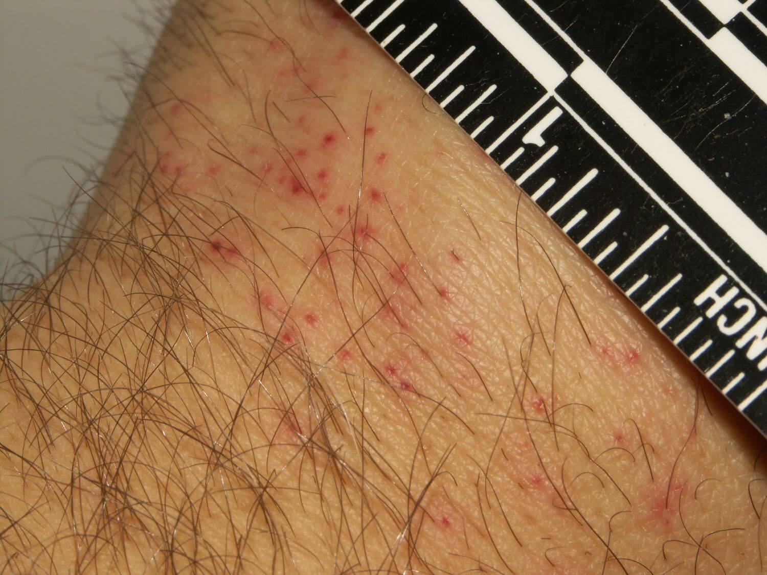 Bed bug bites but no sign of bed bugs