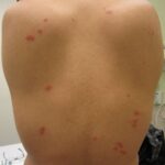 How long do bed bug bites itch