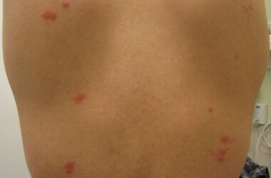 How long do bed bug bites itch