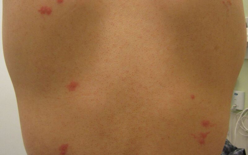 How long do bed bug bites itch