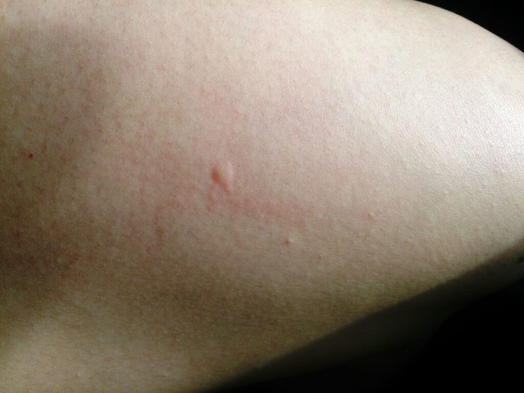 What mosquito bites look like