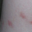 Bed bug bites vs flea bites