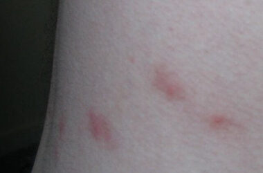 Bed bug bites vs flea bites