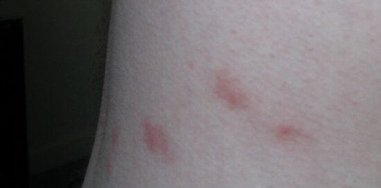 Bed bug bites vs flea bites