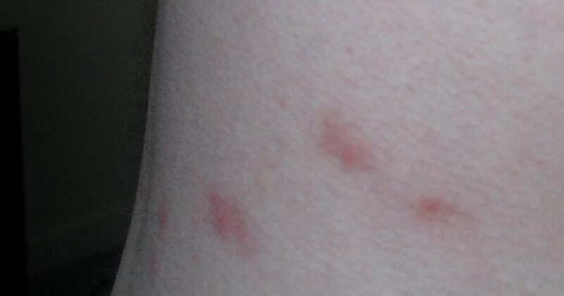 Bed bug bites vs flea bites