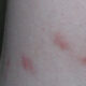 Bed bug bites vs flea bites