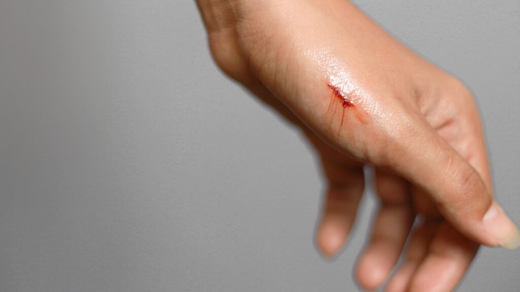 Can Mouse Bites Make You Sick?